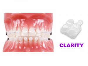 Clarity 3M Unitek vs. другие эстетические брекеты: в чём разница?
